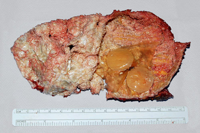 Fig 3 The inside surface of an implant capsule that has been opened